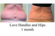 trevor schmidt, my shape lipo, liposuction contest, liposuction specialist, lipo